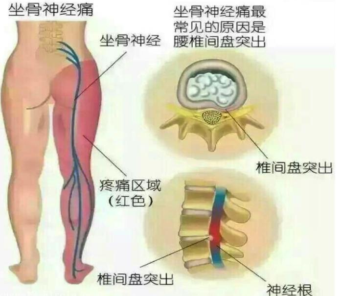 坐骨神经痛.jpg